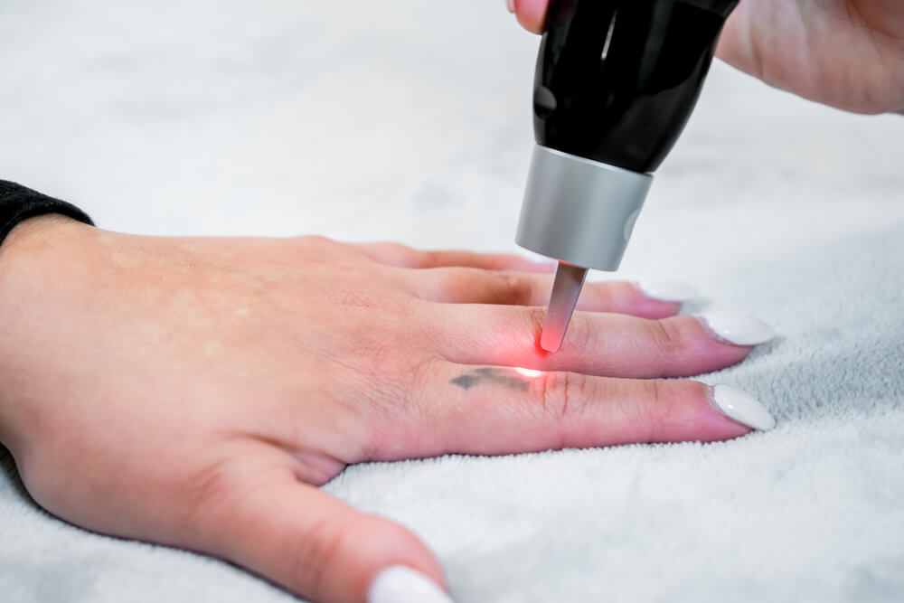 Picosecond laser tattoo removal on a small black tattoo